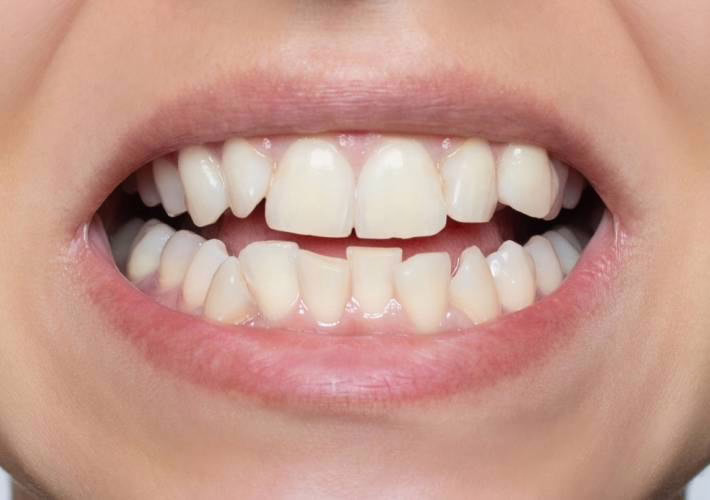 Schiefe Zähne vor dem Anlegen von WellaSmile